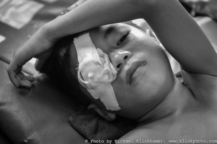cataract surgery boy in Cambodia_klinkhamerphoto