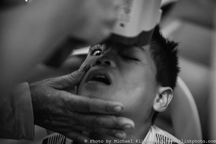 cataract surgery_boy Cambodia hospital_eyecare_klinkhamerphoto